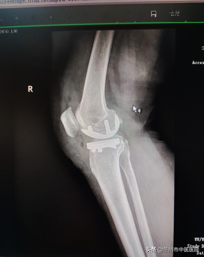 兰州市中医骨伤科医院官网,兰州市中医骨伤科医院的康复科