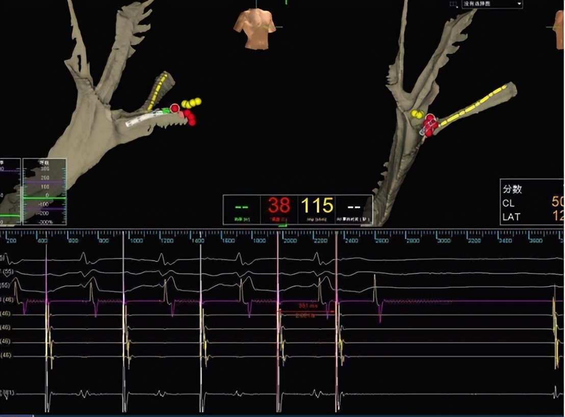 室上速儿童射频消融术最佳年龄,儿童做室上速心脏射频消融哪里好