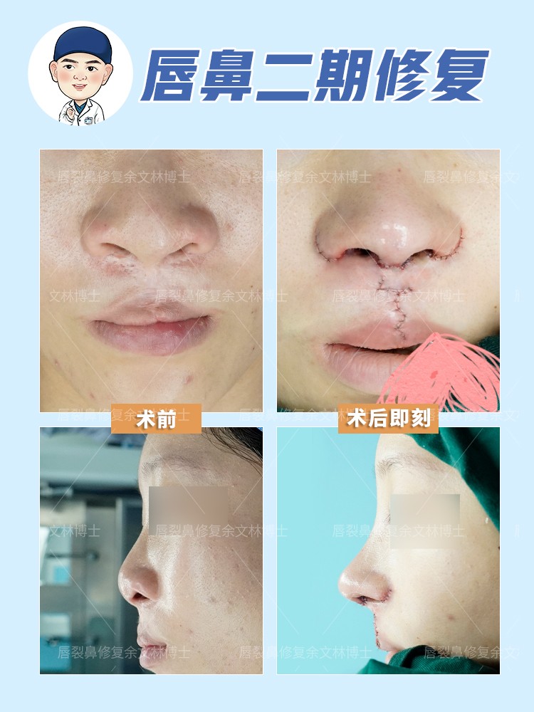 唇裂二期修复术后怎么护理,唇裂修复手术后疤痕疙瘩中医治疗