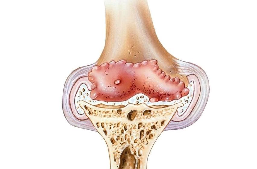 走路时膝盖突然软一下怎么回事,走路时候膝盖突然软一下什么原因