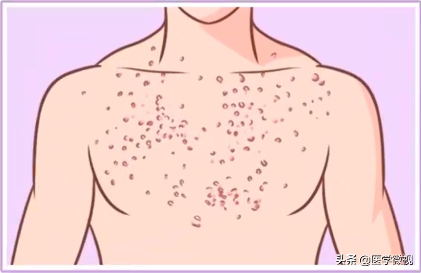 夏天脸上过敏发红发痒起小痘痘,身上有一坨鸡皮疙瘩似的小痘痘