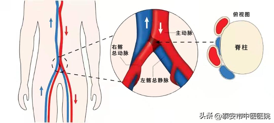 下肢静脉曲张引起的溃疡康复理疗,中医治疗下肢溃疡