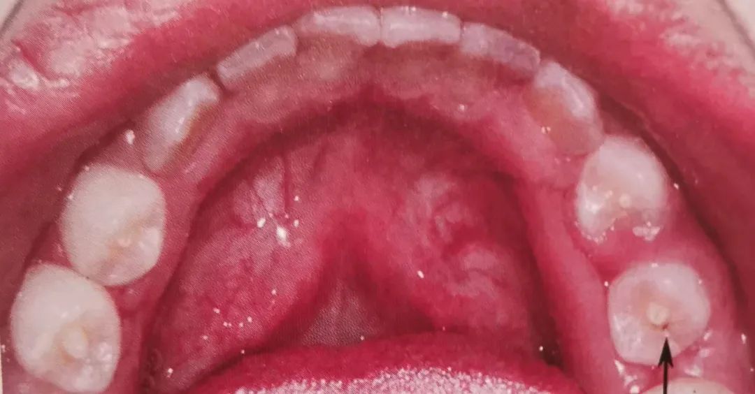 孩子突然牙痛紧急处理方法,儿童半夜突然说牙痛但牙没有问题