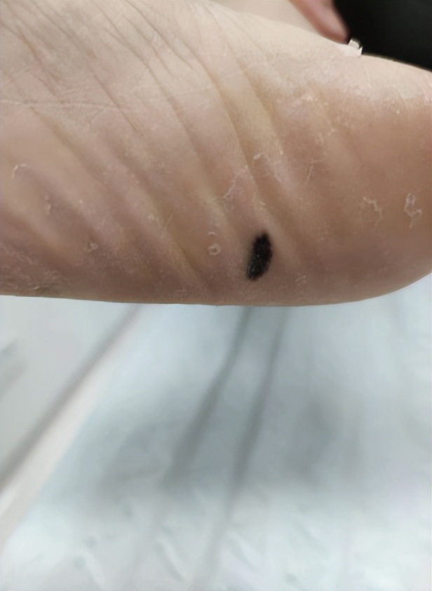 黑痣和黑色素沉着有何区别,什么样的黑痣要警惕可能会恶变