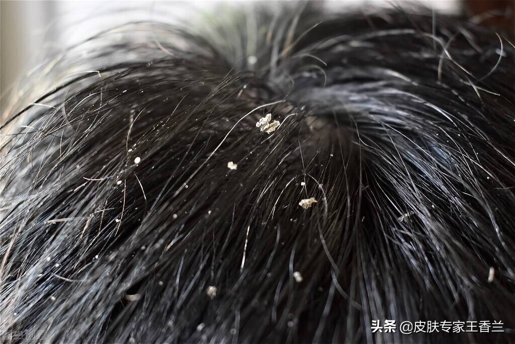 炉甘石洗剂治疗糖尿病皮肤瘙痒,炉甘石洗剂对皮肤瘙痒有效果吗