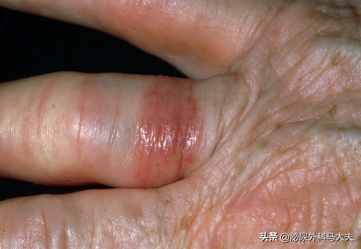 包皮过长用包皮阻复环有用吗,假性包皮戴阻复环有效吗