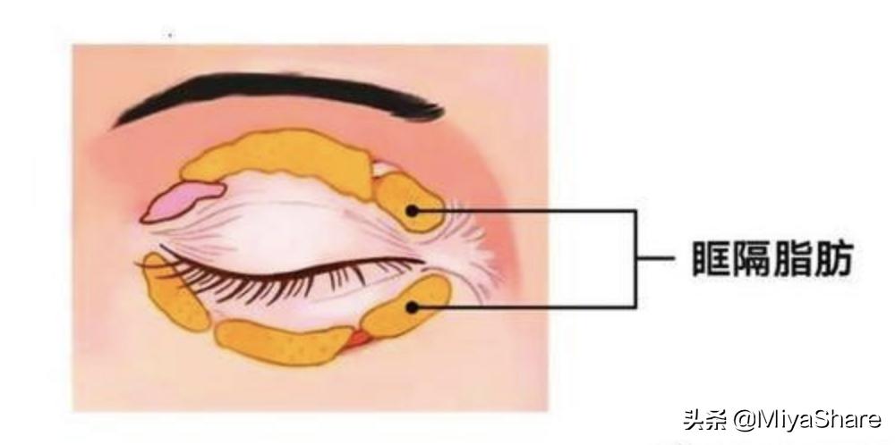 眼袋手术1-7天对比照片,分享眼袋手术亲身经历