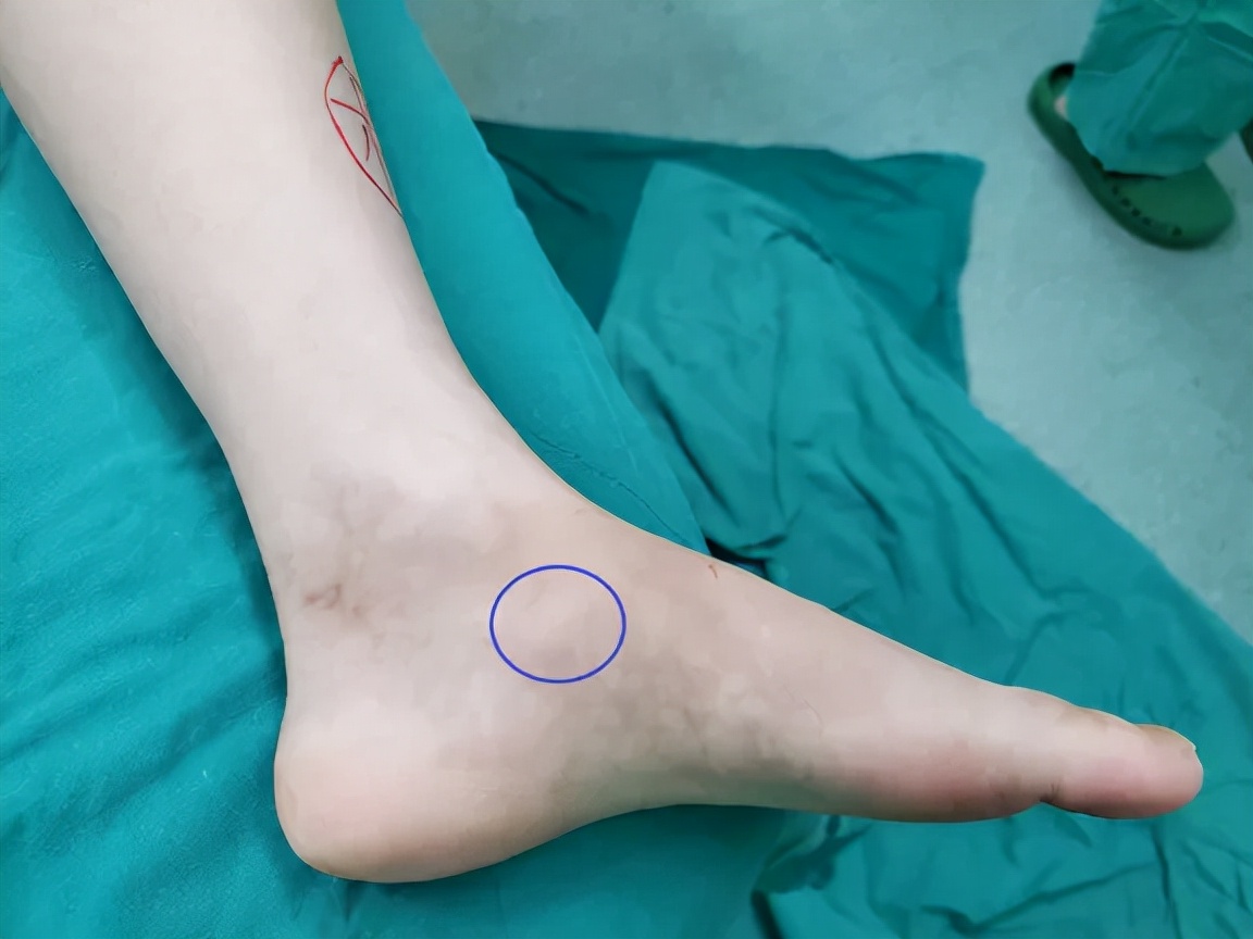 小孩运动后脚疼怎么办,孩子运动后足内侧疼痛