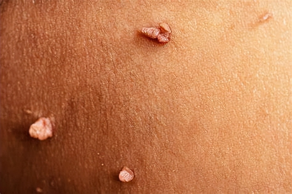 激光治疗皮赘痛,皮赘冷冻治疗视频