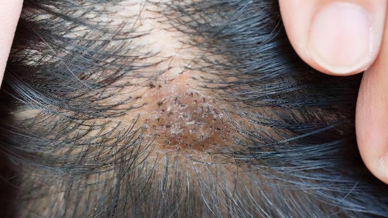 天天洗头还是很多头皮屑如何解决,天天洗头很多头皮屑什么原因