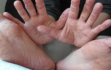 孩子查出免疫性血小板减少症，日常如何调养？5点原则要记牢