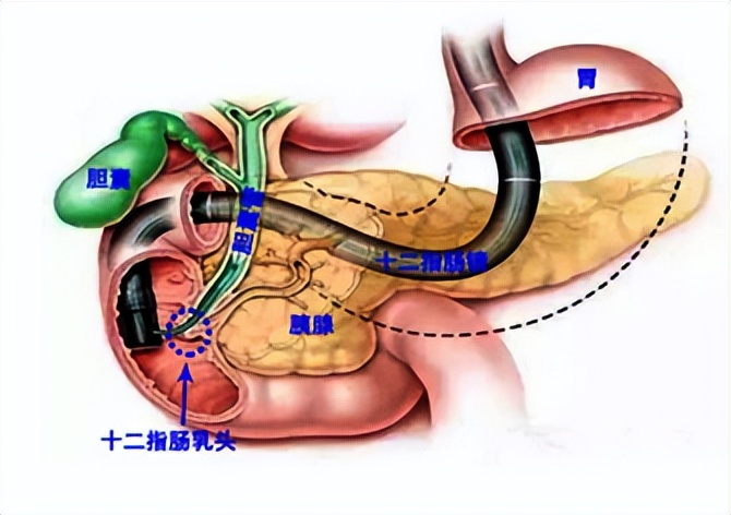 胆囊切除后腹胀怎么回事,胆囊切除术后腹胀怎么办