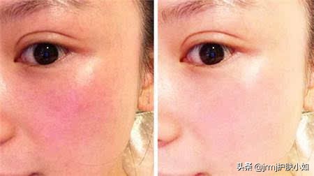 脸部红血丝怎么消除小窍门,脸部红血丝怎么去除最有效
