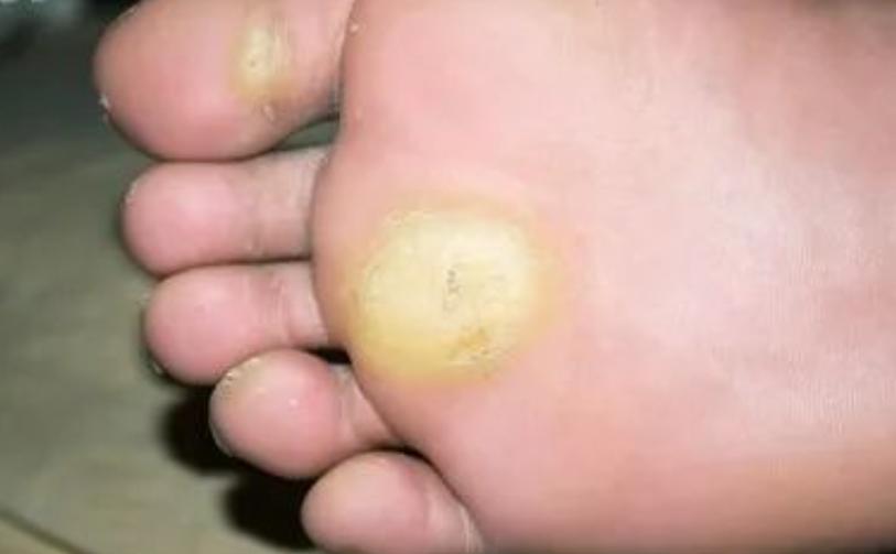 脚底板爱出汗怎么解决,脚底板爱出汗是什么原因造成的