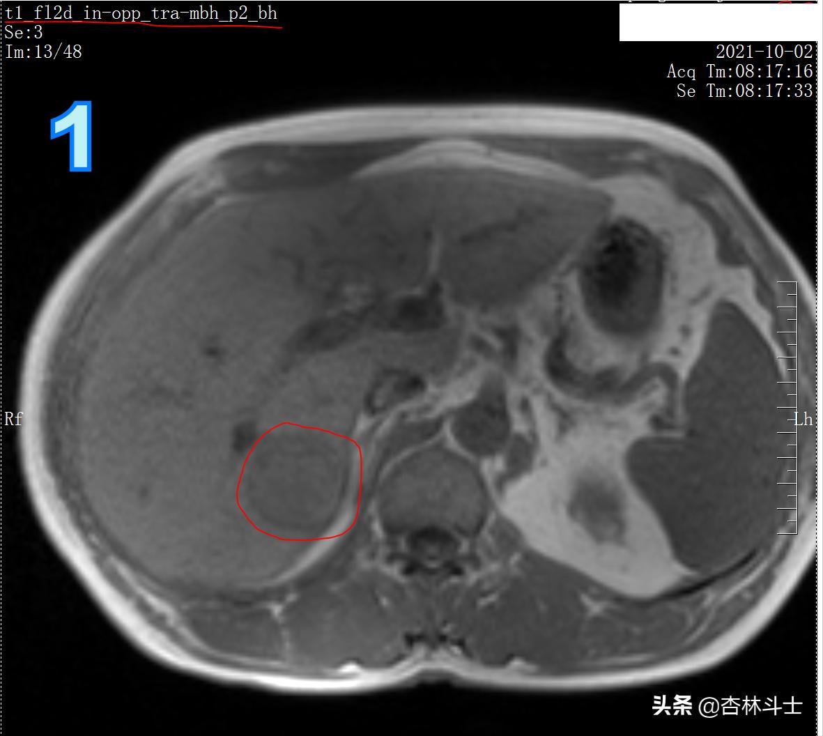 肝癌8公分肿瘤能活多久,肝癌细胞最大长多大