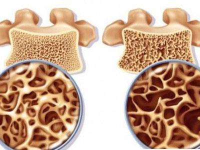 普罗力治疗骨质疏松,雌激素治疗骨质疏松
