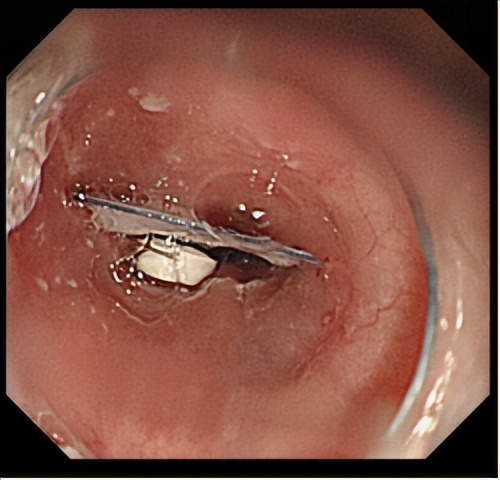 险！七旬依姆误吞药片及包装！卡在食管，最终……