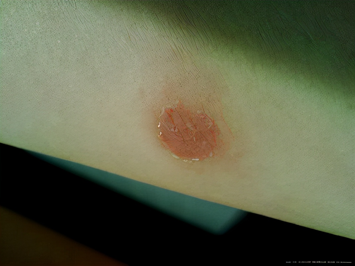 猫癣传染人的症状和治疗,猫癣治疗一般花费多少钱