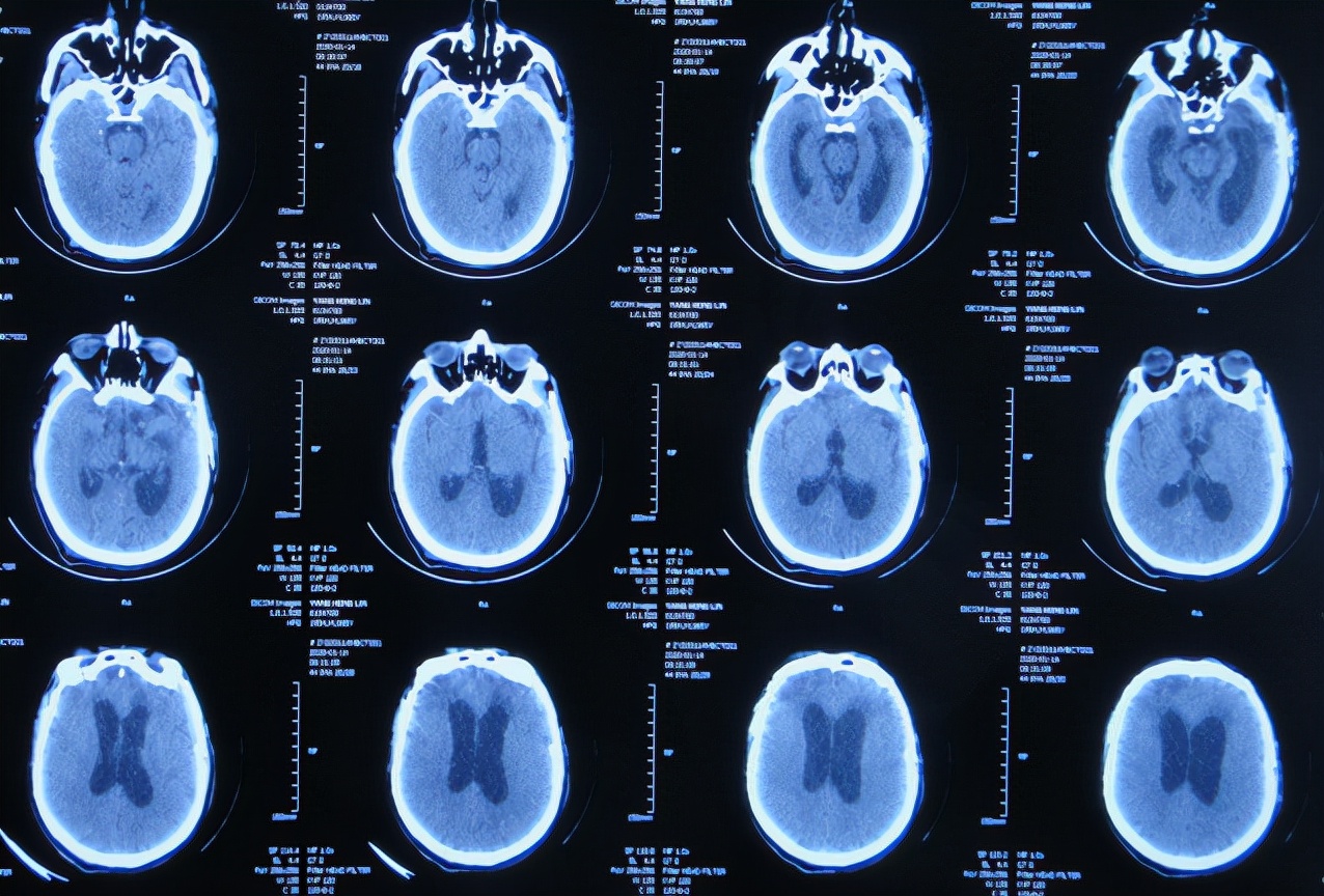 脑外伤后硬膜下积液颅骨修补,颅骨修复手术失败导致脑积水