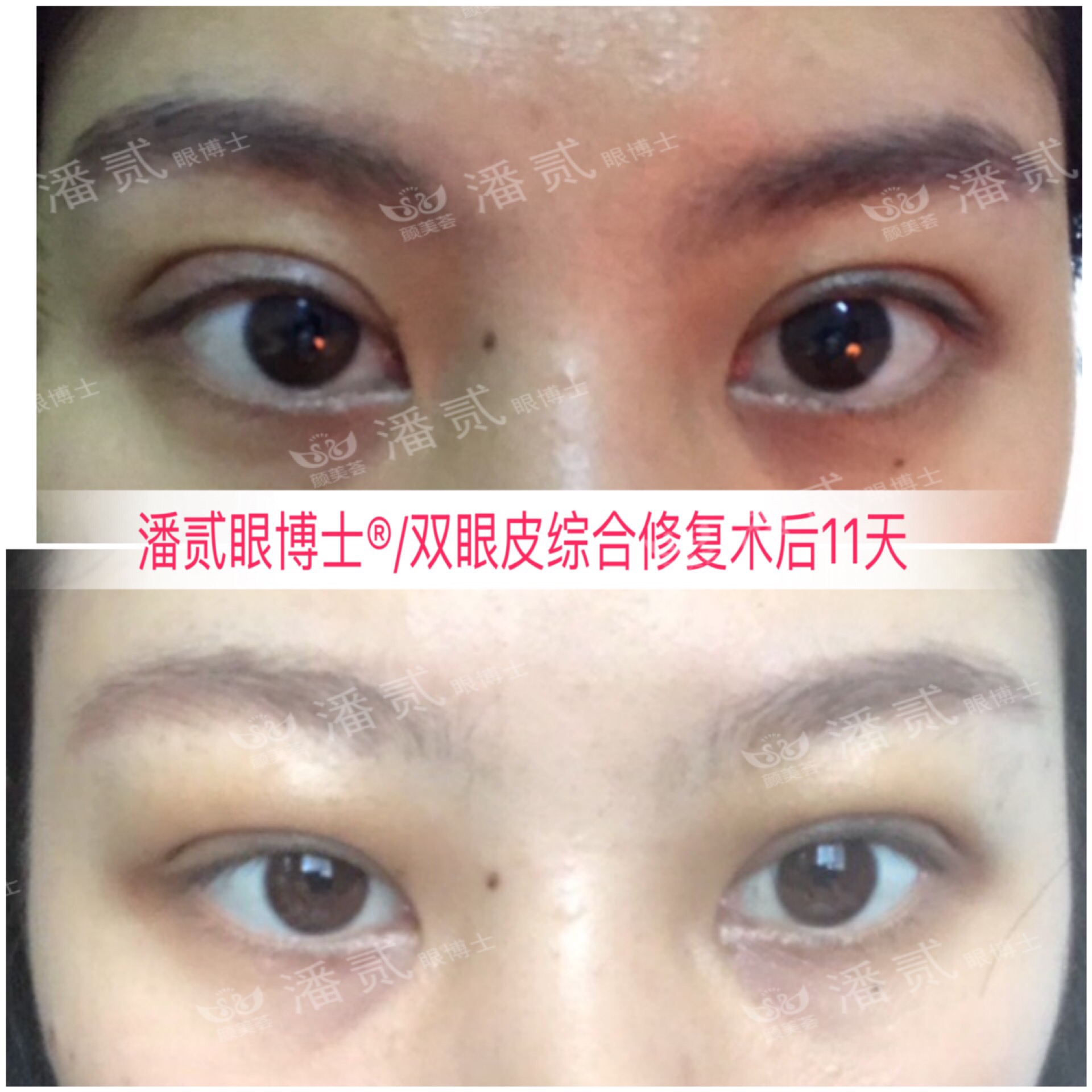 双眼皮贴导致眼皮破了,双眼皮贴导致眼皮严重下垂恢复