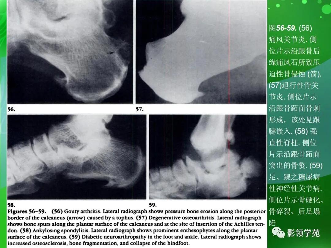 正常跟骨影像图,跟骨正常与变异影像表现图片