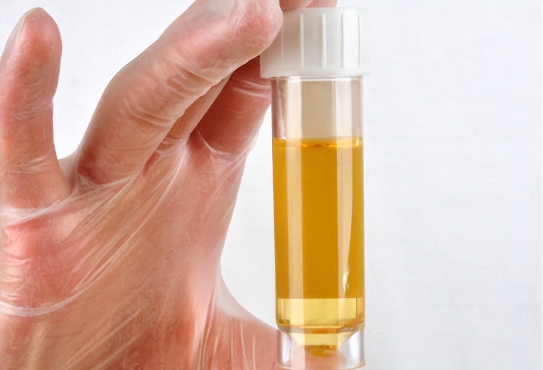 尿液柠檬黄是什么原因引起的,尿液黄泡沫多是什么原因