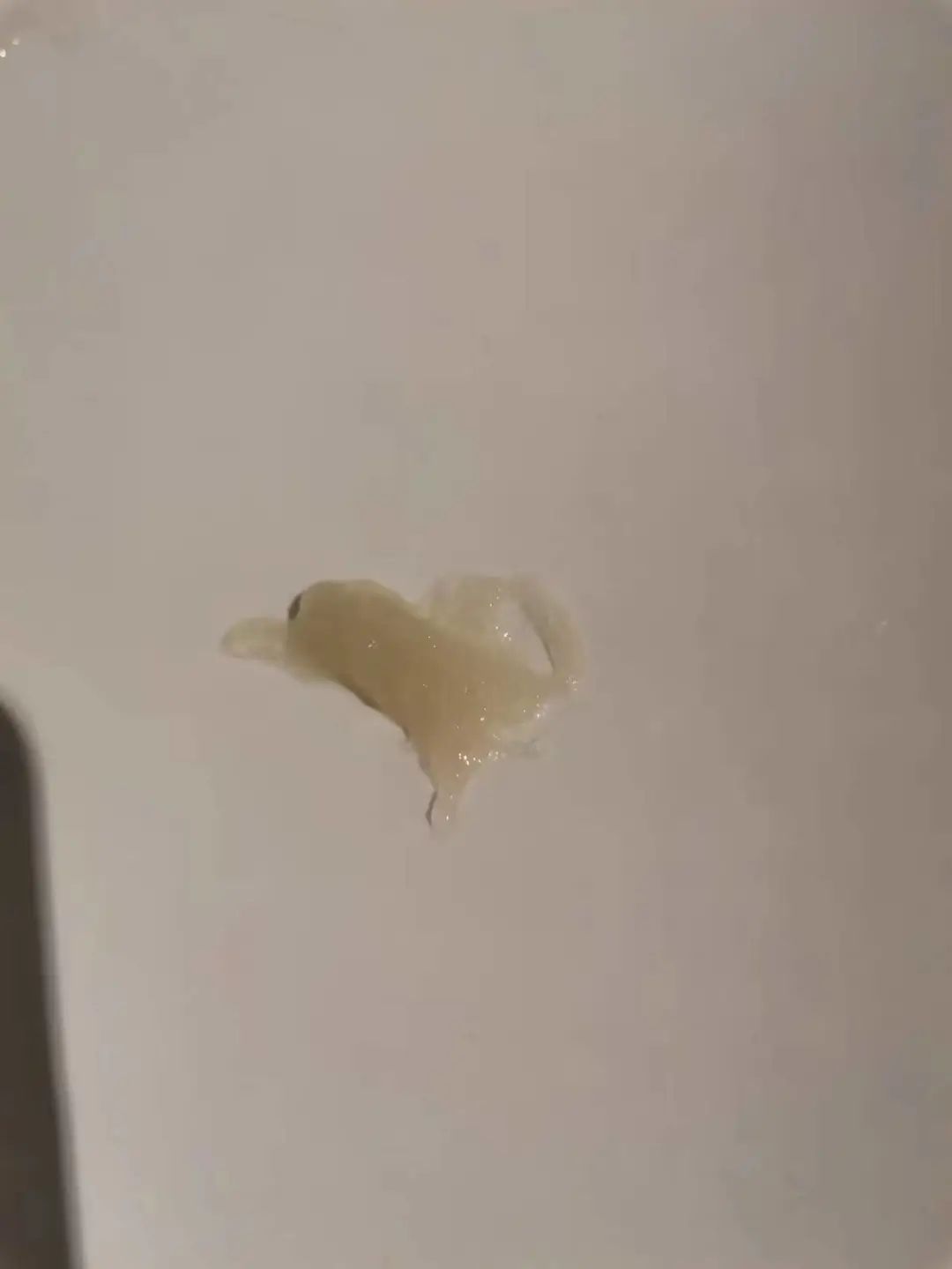 当哮喘患者咳出果冻样、啫喱样，甚至是长条形痰栓，究竟怎么了？