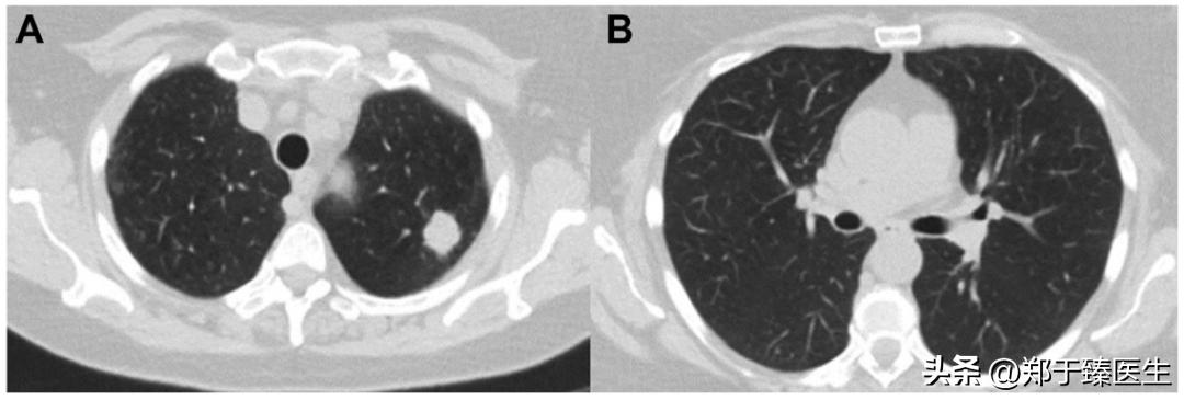 当癌症遇到新冠会怎么样,当癌症病人感染新冠病毒怎么办