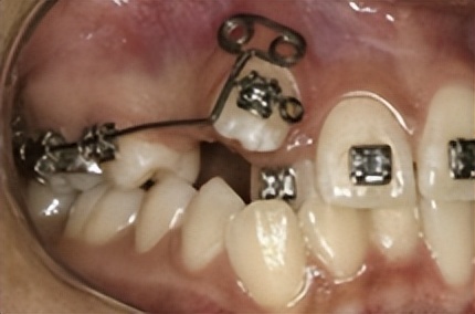 拔牙矫正后多长时间能合缝,拔牙矫正需要缝线吗