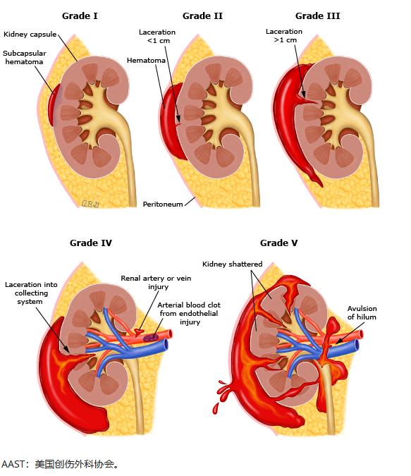 钝性闭合性肾损伤的诊治策略