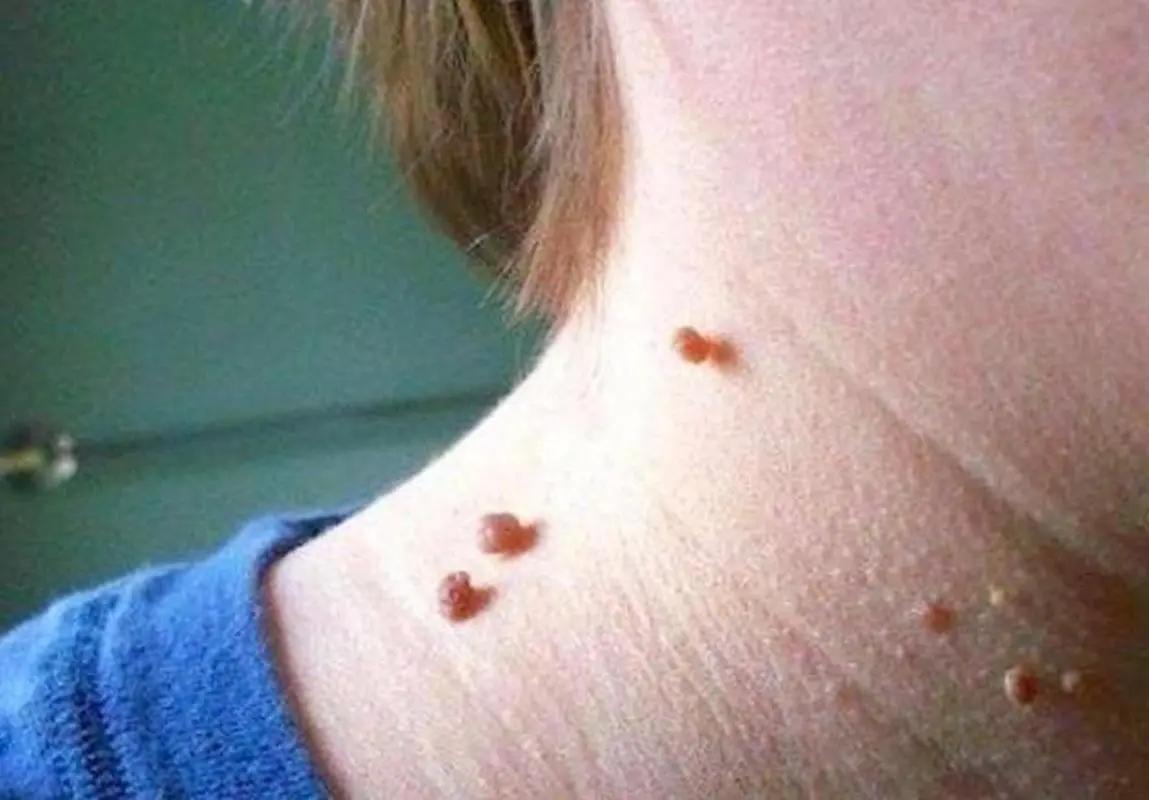 脖子和腋下总长“小肉粒”？可以用手揪吗？医生：与7种疾病有关