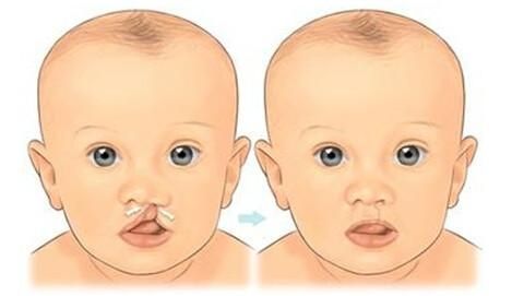 唇裂术后会不会留疤？家长的在意点尤其重要