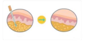 三甲整形医院抽脂医生,吸脂瘦脸整形有名医师