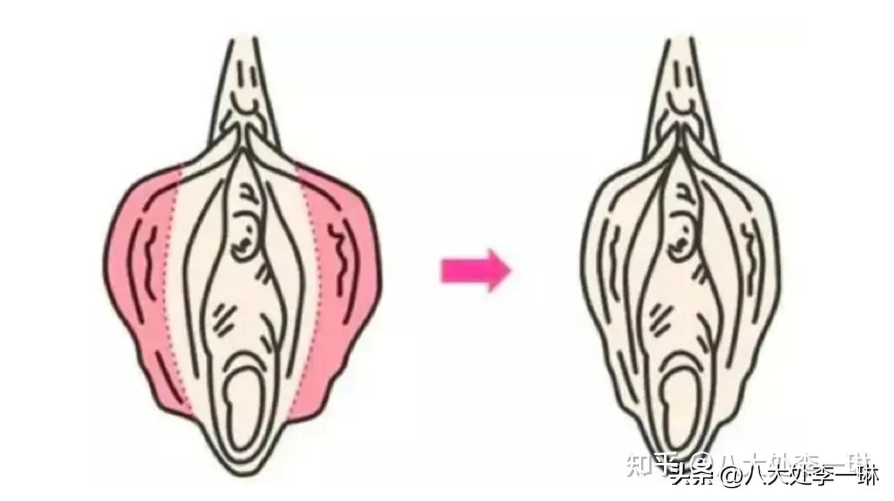 小阴唇肥大整形常见问题功课贴