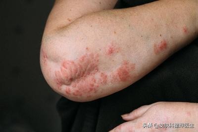 皮肤神经性皮炎怎么办,神经性皮炎要看皮肤科还是血液科