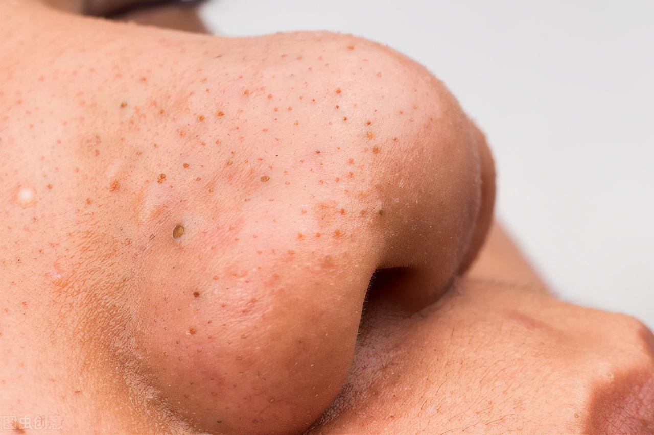 黑头在显微镜上是什么东西,脸上的黑头