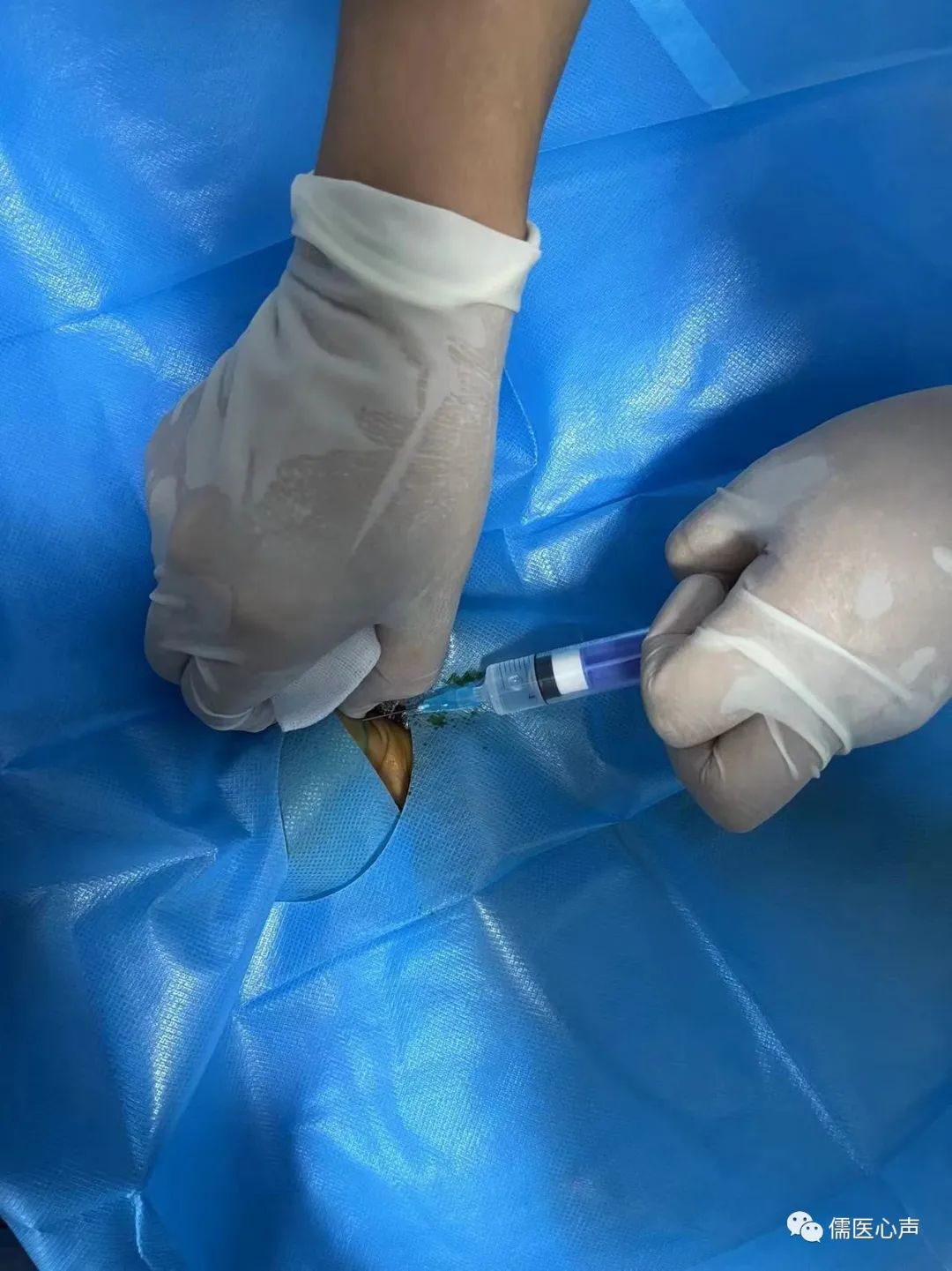 女童大拇指不能伸直,女宝三岁大拇指伸不直用做手术吗