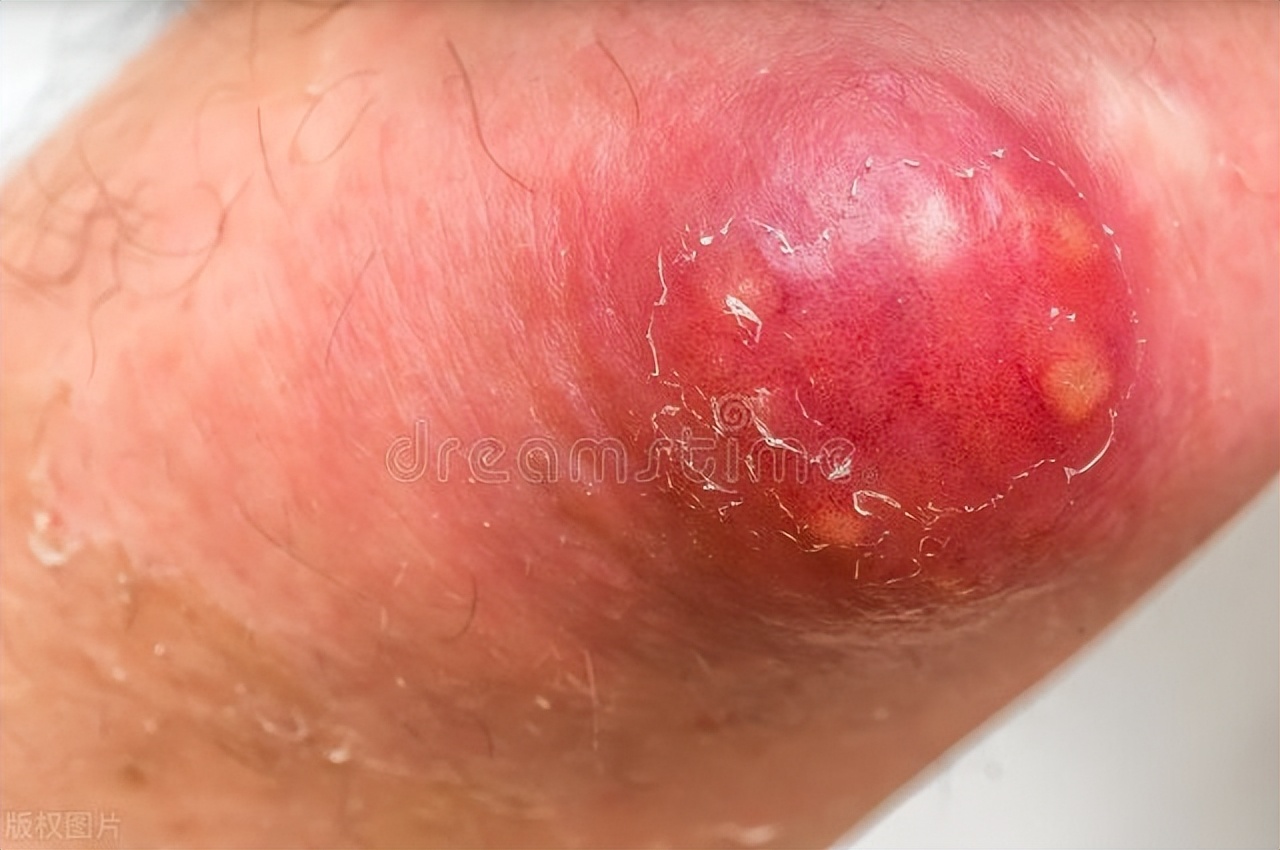 长个疖肿怎么消下去,长了小的疖肿会自行消退吗