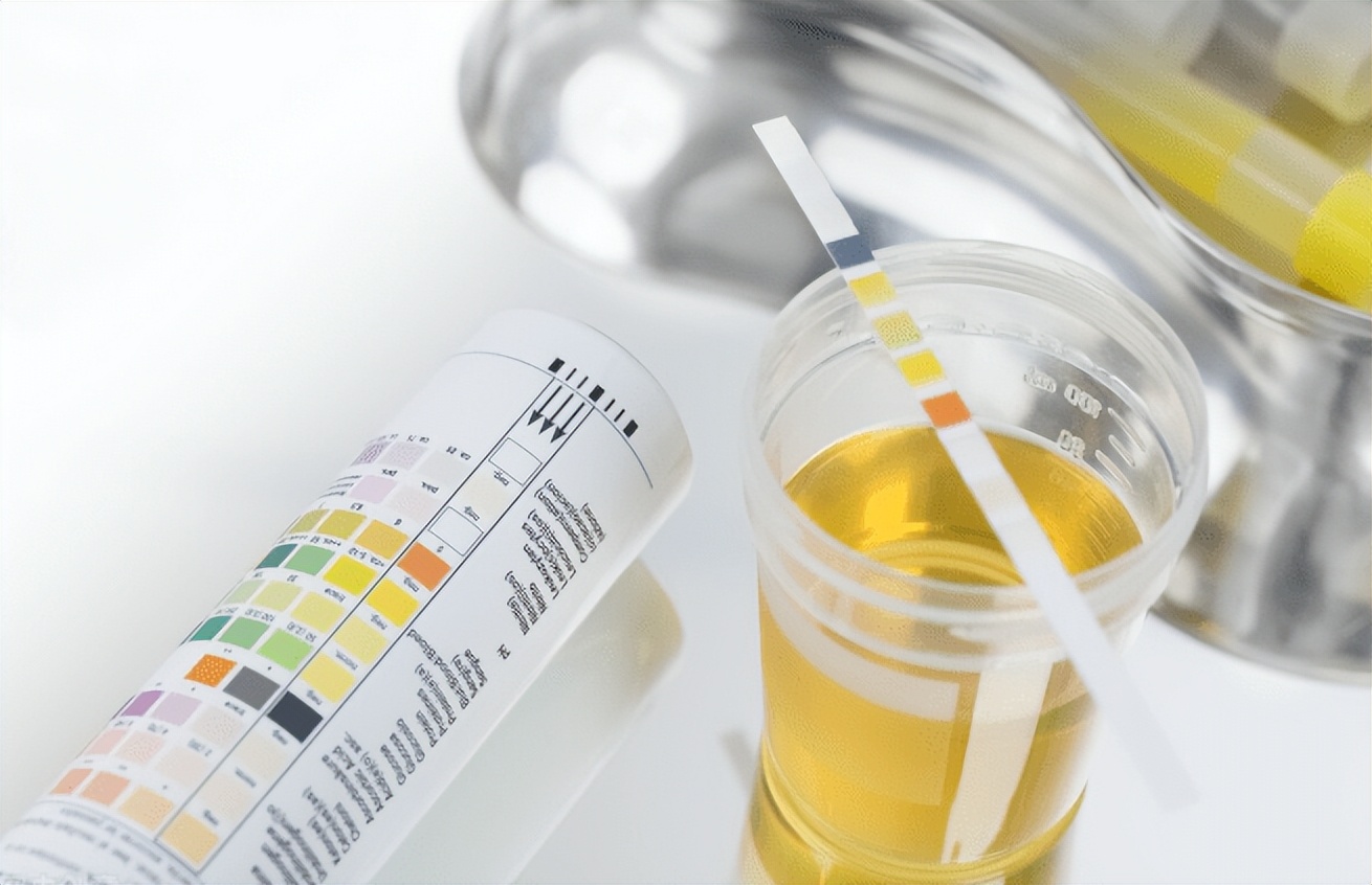 妊娠期尿蛋白高怎么办,妊娠期尿里有轻微蛋白严重么