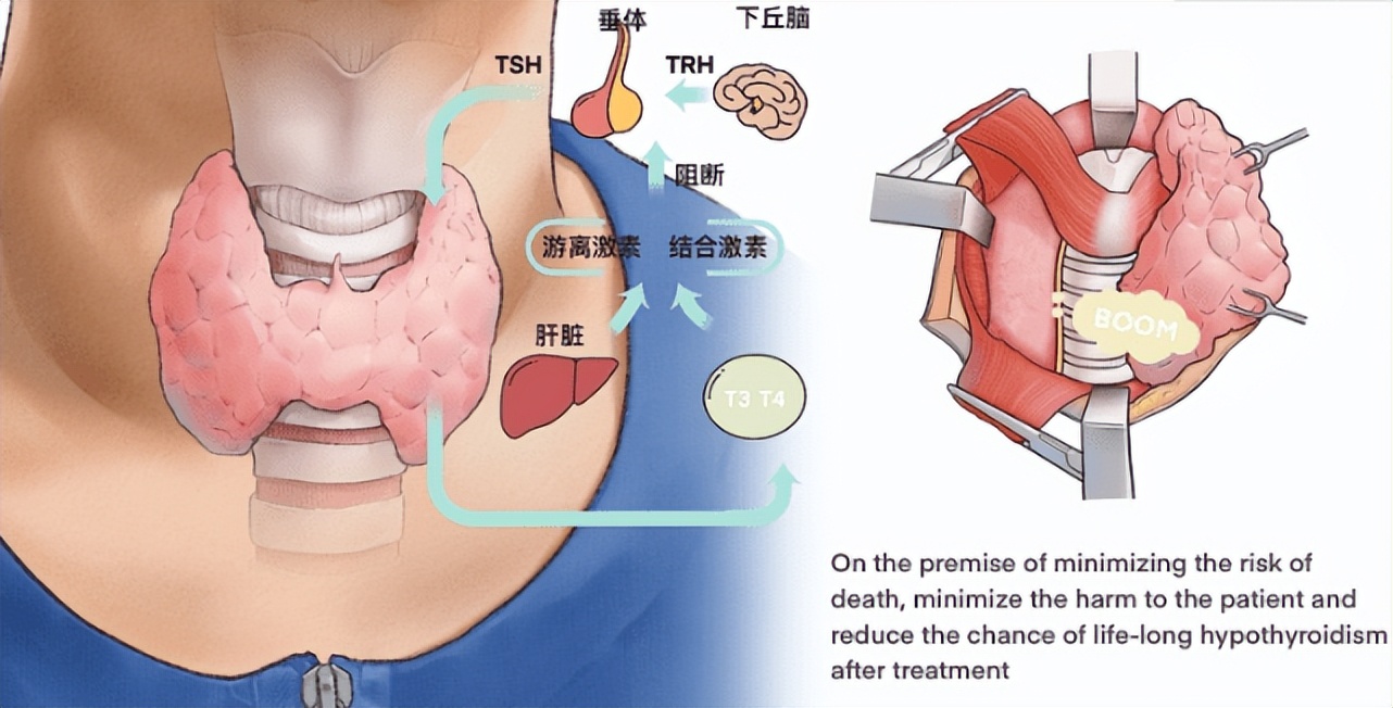 女性桥本甲状腺炎对怀孕的影响,桥本甲状腺炎会引起心脏问题吗