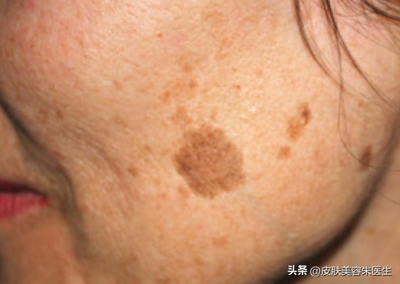 长凸出来的老年斑会是得了癌症吗,40岁老年斑增多是癌症的征兆