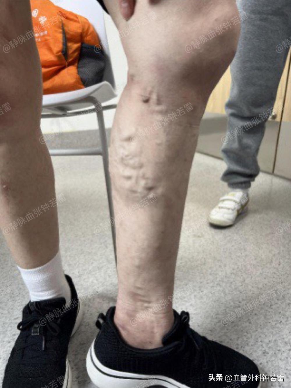 静脉曲张并发血管炎折磨了三代人，联合微创轻松告别“蚯蚓”！