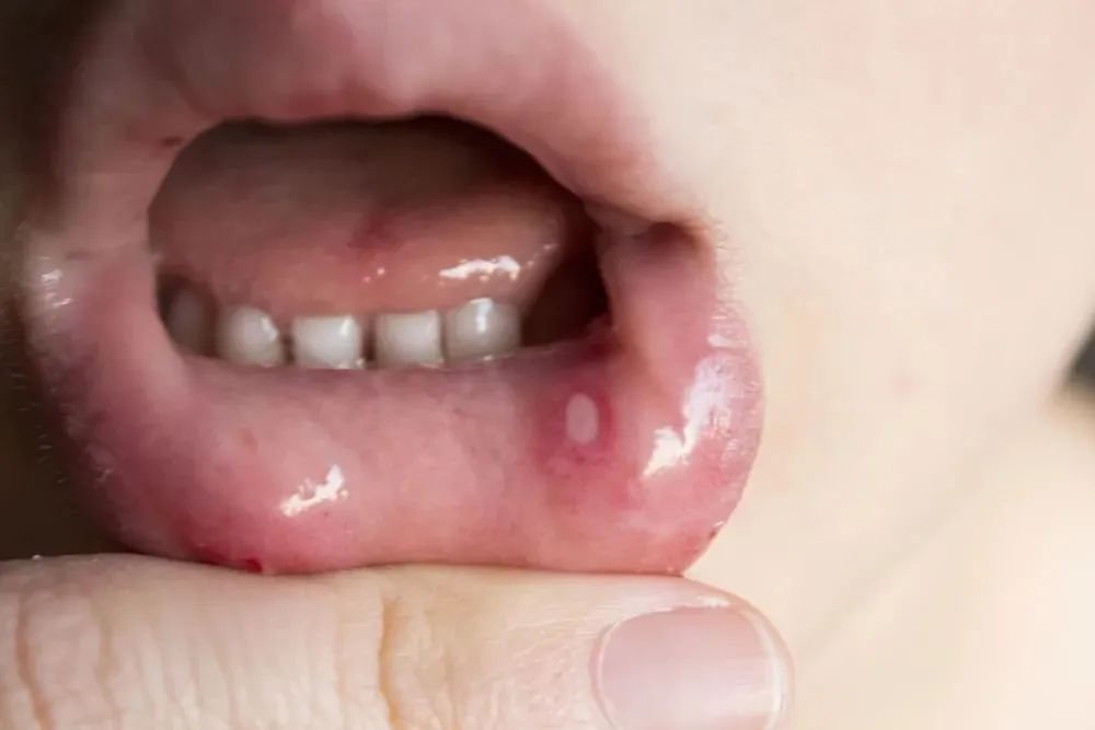 儿童口腔溃疡怎么办才好得快些,孩子口腔溃疡反复发作怎么办