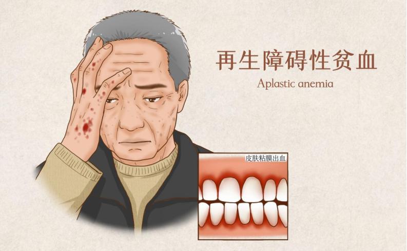 乏力流鼻血,再生障碍贫血流鼻血是什么样的