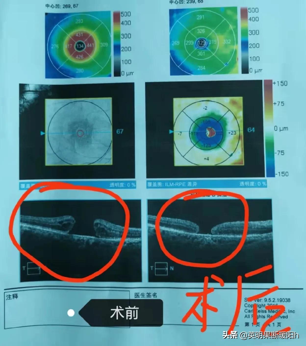 眼睛黄斑裂孔中医能治好吗怎么治,眼睛黄斑裂孔有什么症状