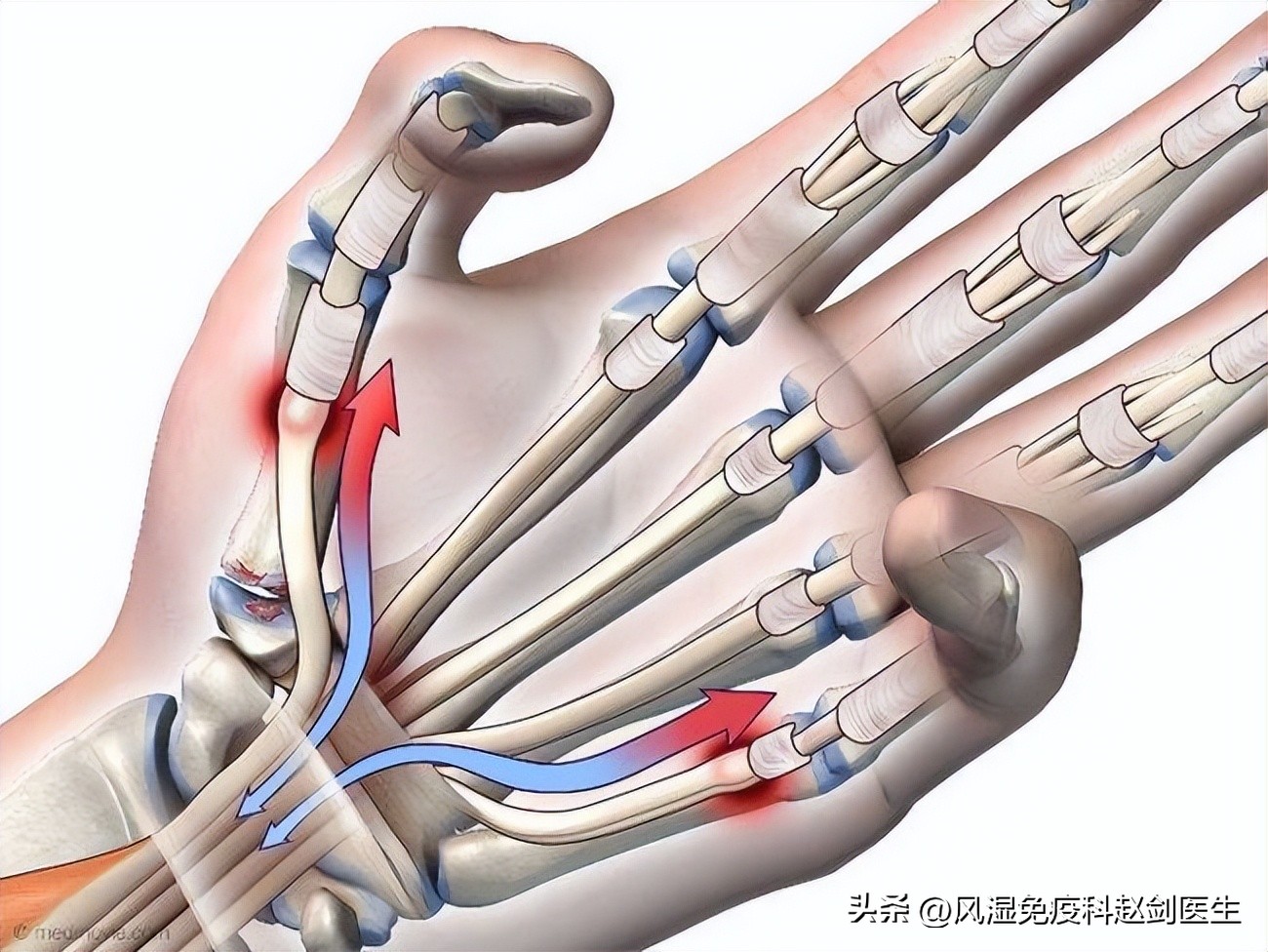 敲键盘手腕酸疼,敲键盘手腕肿痛
