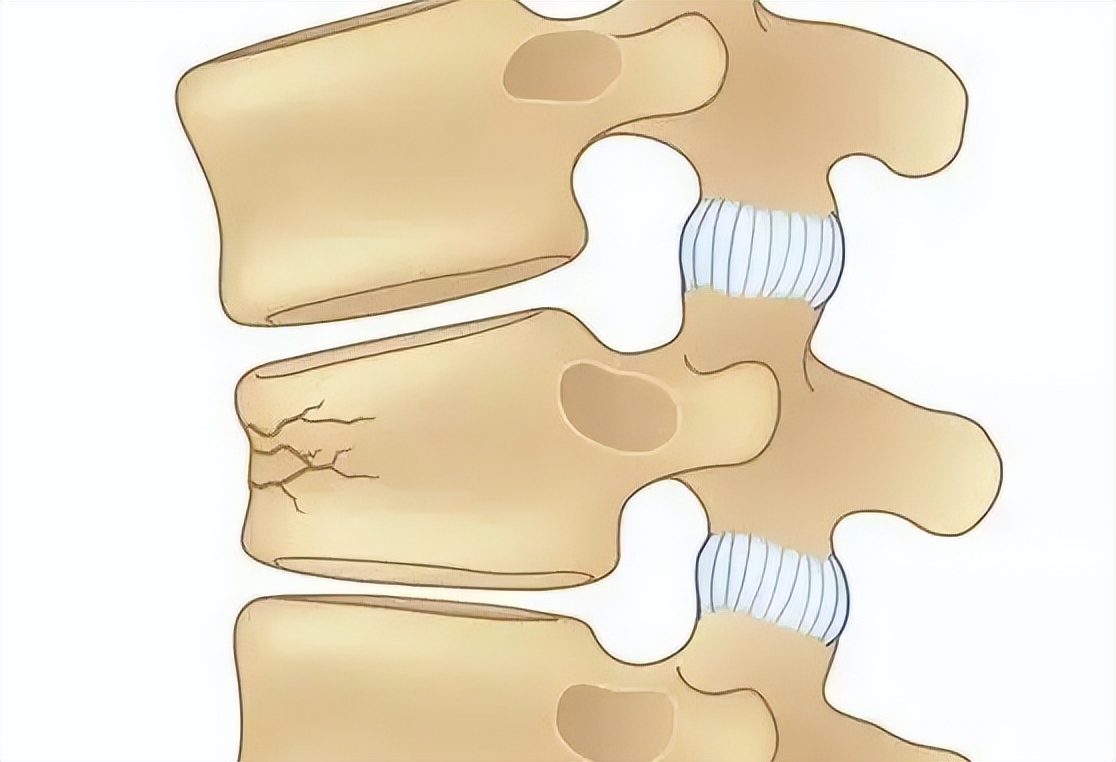 腰椎骨折的处理步骤,腰椎骨折的症状及表现