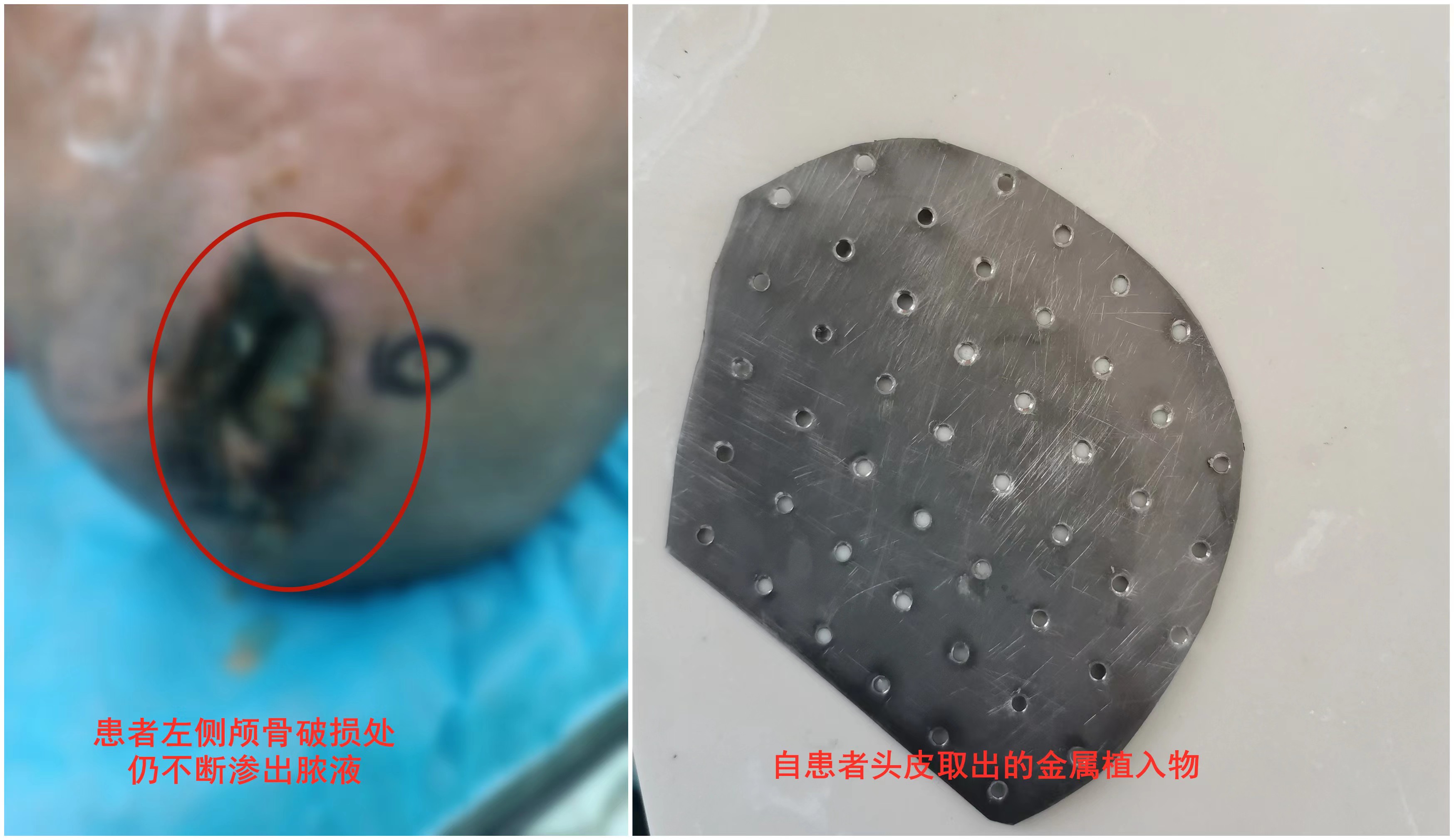 颅骨修补后脑袋不正常了,颅骨修补一个月后出现线头外露