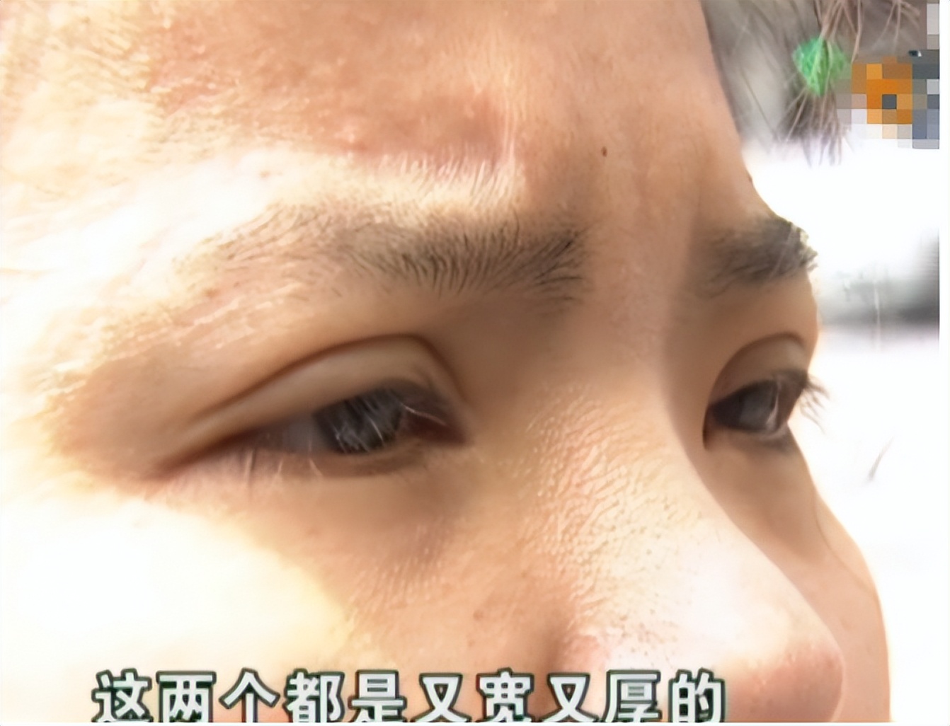 河南两兄弟割双眼皮被劝退,郑州割双眼皮失败男子
