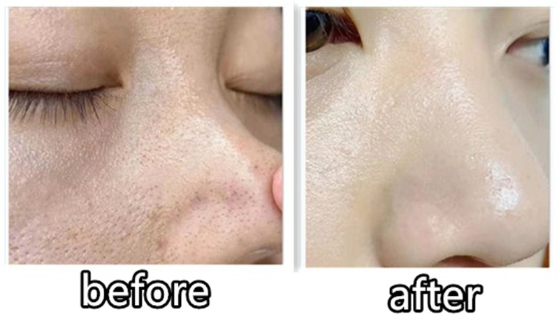 挤黑头用什么收缩或张开毛孔,挤黑头后毛孔大怎么物理修复